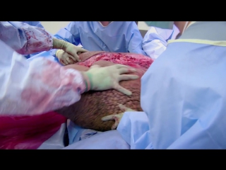 an operation of more than 8 hours   the largest testicles in the world